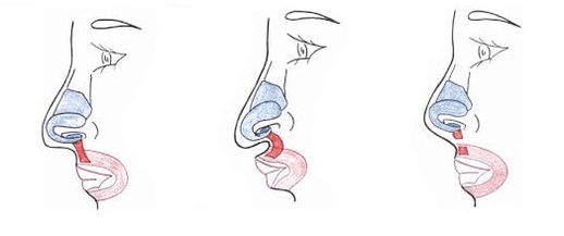 Βραχύνωση τμήματος του ρινικού μυός