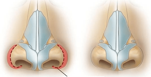 Μείωση των ρουθουνιών
