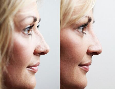 Πριν και μετά τη ρινοπλαστική με fillers