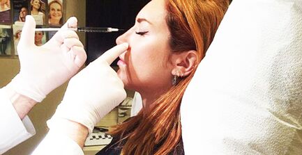 Ρινοπλαστική με fillers