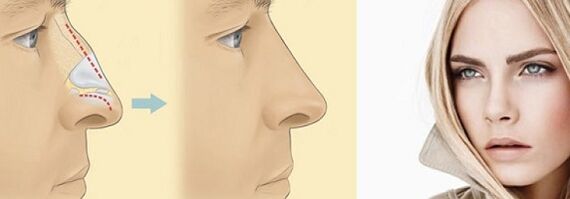 Διόρθωση του σχήματος της μύτης με μη χειρουργική ρινοπλαστική