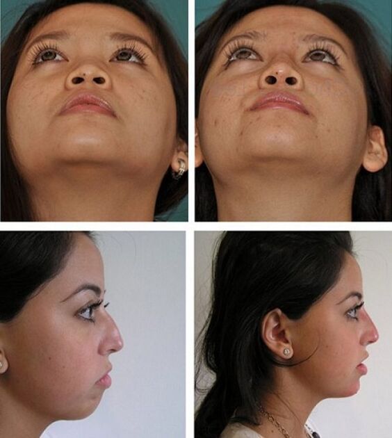 Φωτογραφίες πριν και μετά από ρινοπλαστική χωρίς χειρουργική επέμβαση
