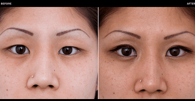 πριν και μετά από χειρουργική επέμβαση στα μάτια
