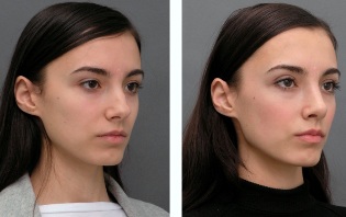 Το κορίτσι πριν και μετά τη ρινοπλαστική η μύτη